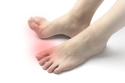 痛風（高尿酸血症）